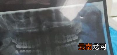 拔完智齿是一种怎样的体验