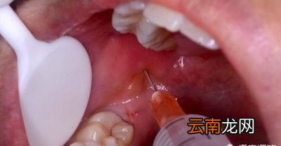 拔完智齿是一种怎样的体验