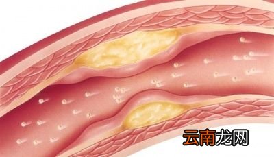 高血糖患者吃花生会不会有问题