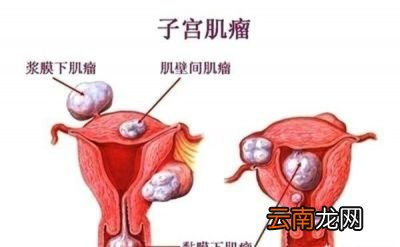 子宫肌瘤会有症状吗