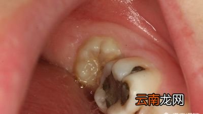 为什么有些女生拔完智齿真的脸瘦