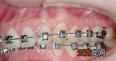 为什么有些女生拔完智齿真的脸瘦