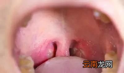 腺样体肥大有什么影响