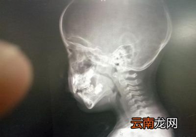 腺样体肥大有什么影响