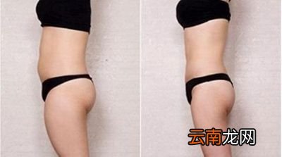 抽脂减肥是一种怎样的体验