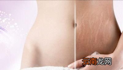 抽脂减肥是一种怎样的体验