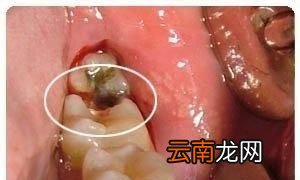 孕妇孕期都有什么口腔问题