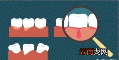 有哪些关于孕妇口腔问题的误区