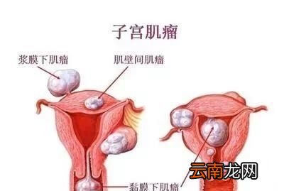 什么是子宫肌瘤