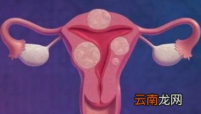 子宫肌瘤需手术治疗吗