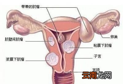 子宫肌瘤需手术治疗吗