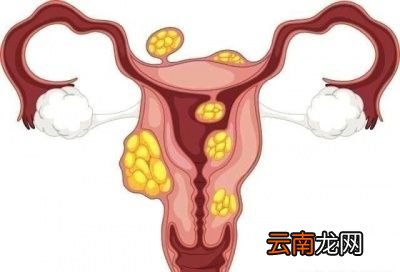 患有子宫肌瘤一定要做手术吗