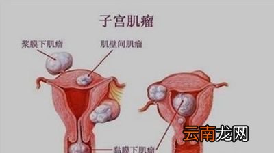 有生育需要的女性患上子宫肌瘤要手术吗