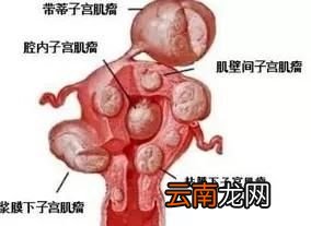 有生育需要的女性患上子宫肌瘤要手术吗