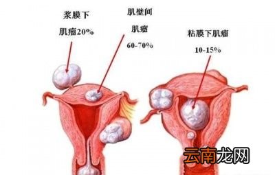 什么样的子宫肌瘤要手术