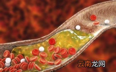 血栓出现时是否可以通过运动改善