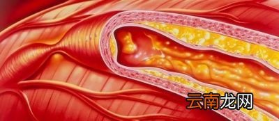 血栓出现后是否可以通过运动来改善呢