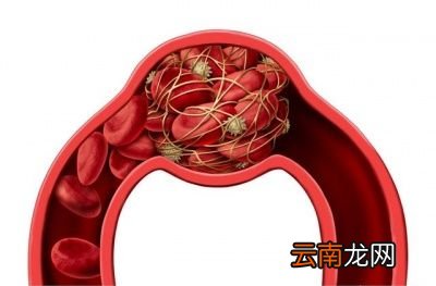 血栓出现后是否可以通过运动来改善呢