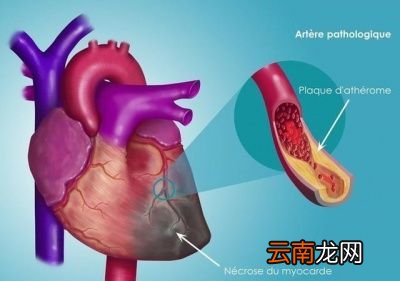 一旦发生心梗脑梗猝死怎么办