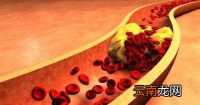 一旦发生心梗脑梗猝死怎么办