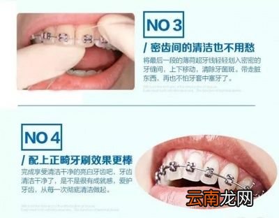 为什么要用牙线或牙线棒