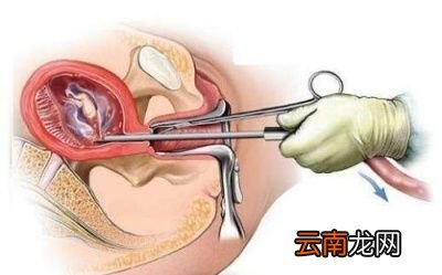 小产以后需要注意什么