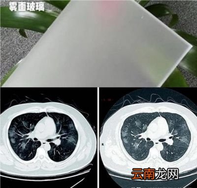 感染后无症状的患者怎么确诊