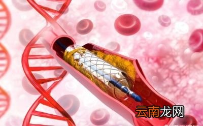 做了心脏支架手术还能喝酒吗有什么建议吗
