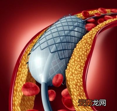 心脏支架手术喝酒会怎么样