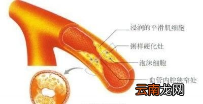 做了心脏支架手术还能喝酒吗