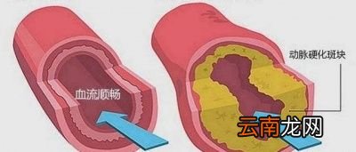 什么是血压高压和低压又是指什么