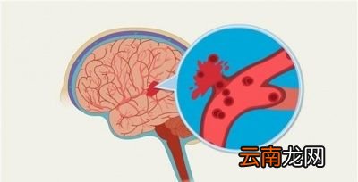 高血压到底是看高压重要还是看低压重要