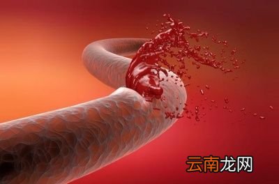 血压到底看高压还是低压