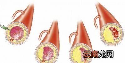血压监测中高压重要还是低压重要
