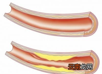 七怎么治愈高血压