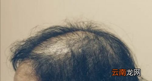 熬夜脱发吃什么维生素