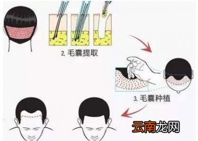 头发移植后会脱发吗