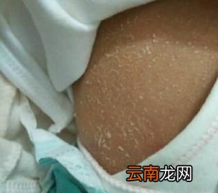 新生儿身上有褪皮是怎么回事呢