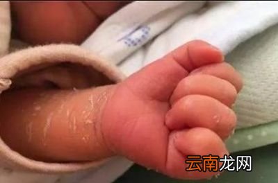 新生儿身上有褪皮是怎么回事呢