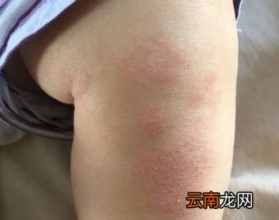 新生儿身上有褪皮是怎么回事呢