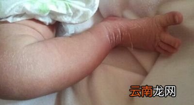 新生儿身上有褪皮怎么回事