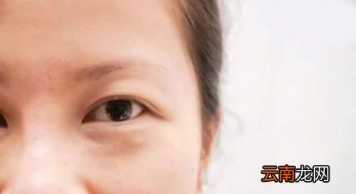眼袋是怎样产生的,如何消除