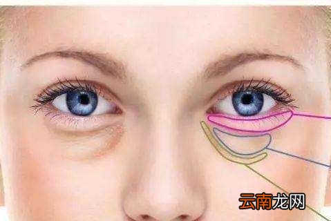 眼袋是怎样产生的,如何消除