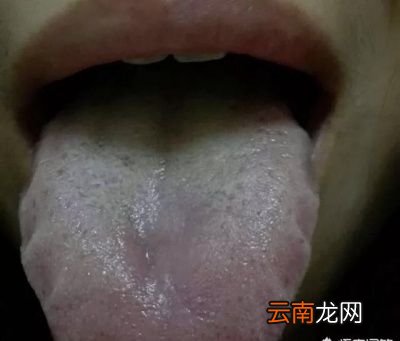 舌头有齿痕怎么调理