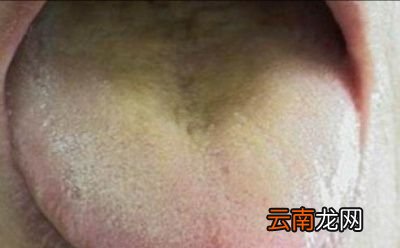湿气重在舌苔上有什么表现呢