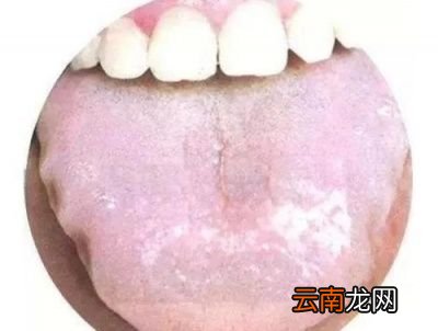 湿气重在舌苔上有什么表现呢