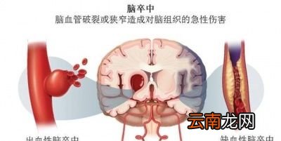 “十宣放血疗法”真的能挽救中风吗