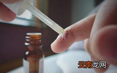 阿司匹林洗头有什么用