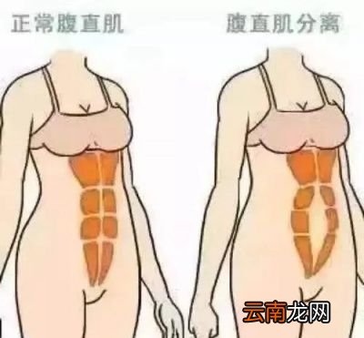 腹直肌分离常见于哪种情况