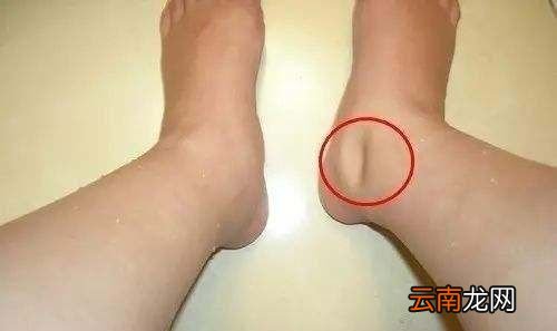 伏天身体湿气重有什么表现